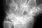 Rheumatoid Arthritis