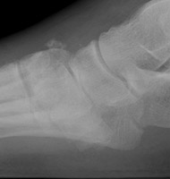 Charcot: Lateral -Fracture-dislocation Lisfrank joint